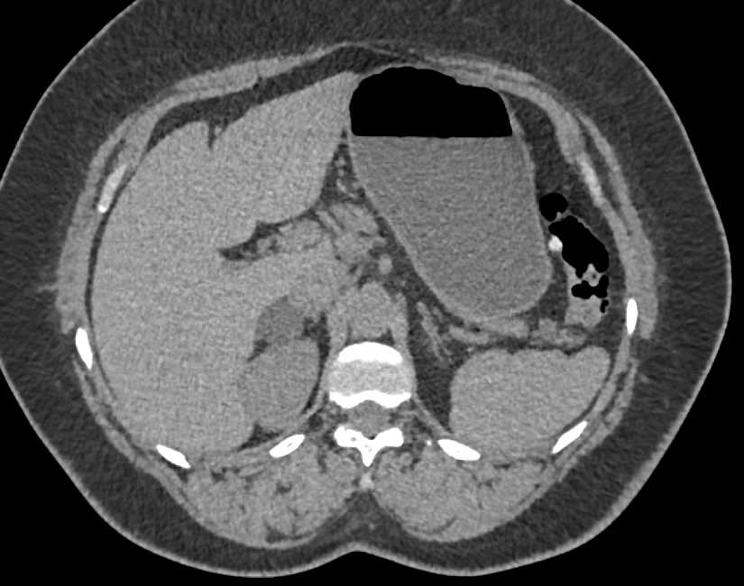 Transitional Cell Carcinoma Left Kidney - CTisus CT Scan