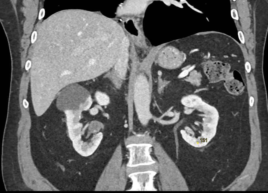 Renal Artery Aneurysm Hilum Right Kidney - CTisus CT Scan