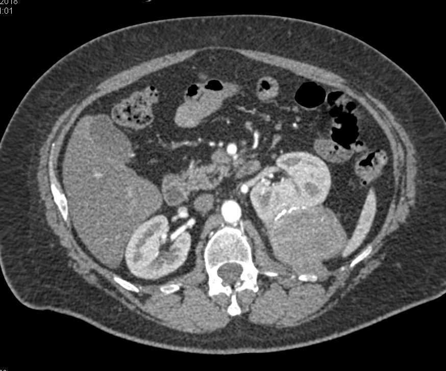 Cystic Renal Cell Carcinoma - CTisus CT Scan