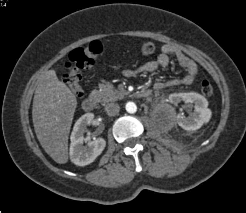 Lymphoma Involves the Left Kidney - CTisus CT Scan