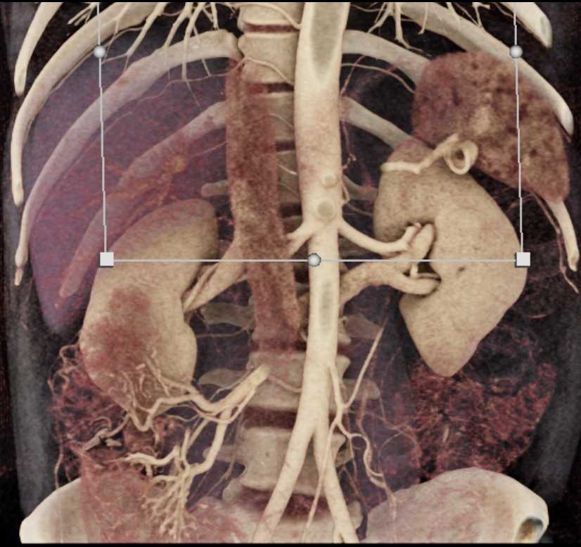 Retroaortic Left Renal Vein - CTisus CT Scan