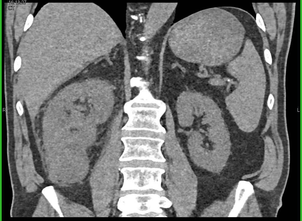 TCC Right Kidney with Renal Vein Thrombus - CTisus CT Scan