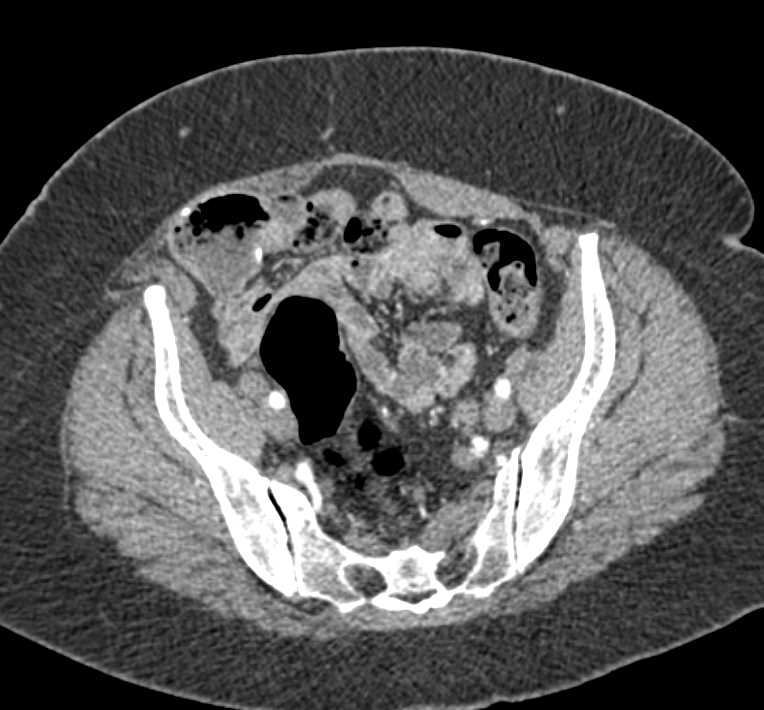 Multifocal Transitional Cell Carcinoma Left Ureter - CTisus CT Scan