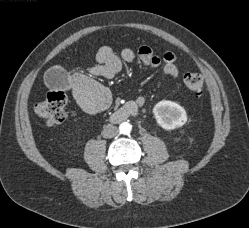 Bladder Cancer with Obstructed Left Ureter - CTisus CT Scan