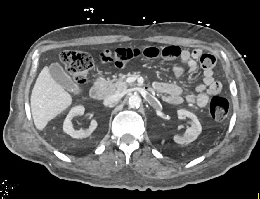 Left Renal Vein Thrombosis - CTisus CT Scan