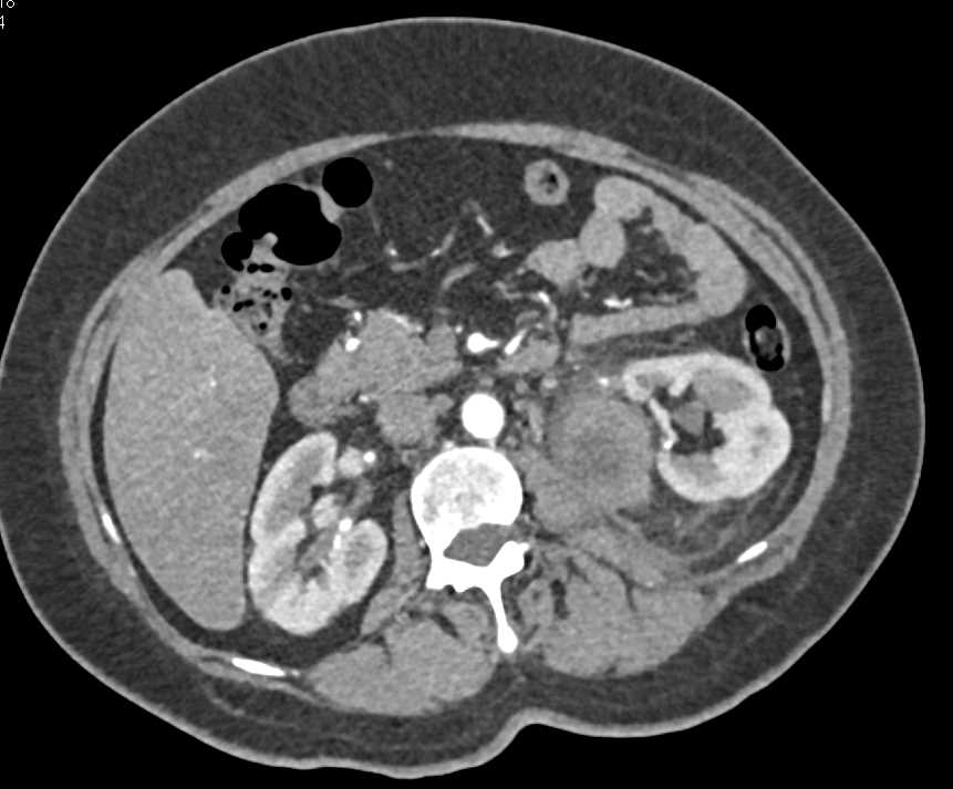 Lymphoma Involves the Left Kidney - CTisus CT Scan