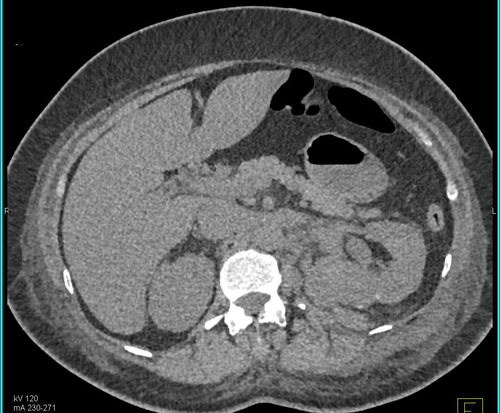 Lymphoma Involves the Left Kidney - CTisus CT Scan