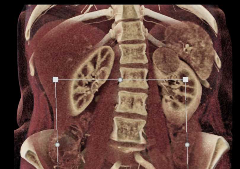 Upper Pole Left Kidney Mass is an Oncocytoma - CTisus CT Scan