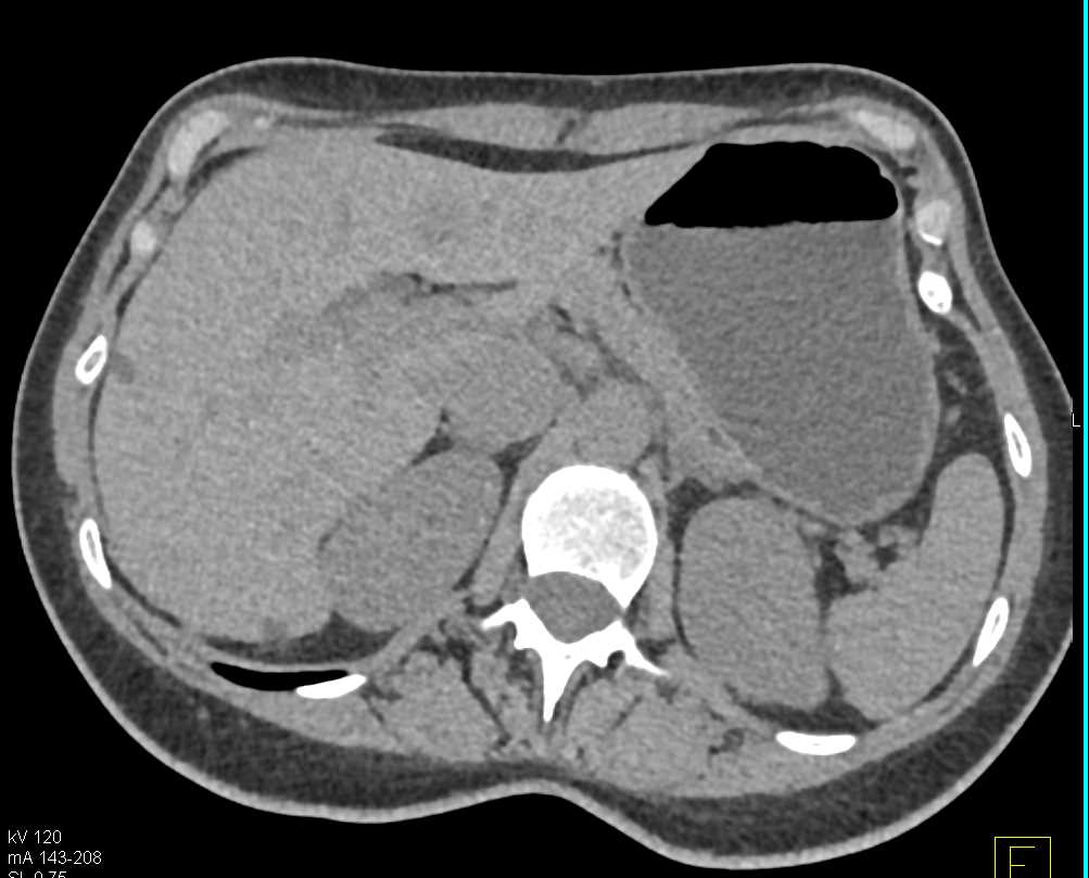 Upper Pole Left Kidney Mass is an Oncocytoma - CTisus CT Scan