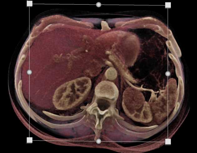 Upper Pole Left Kidney Mass is an Oncocytoma - CTisus CT Scan