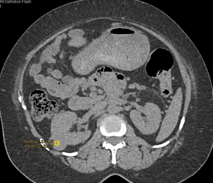 Papillary Renal Cell Carcinoma Right Kidney - CTisus CT Scan