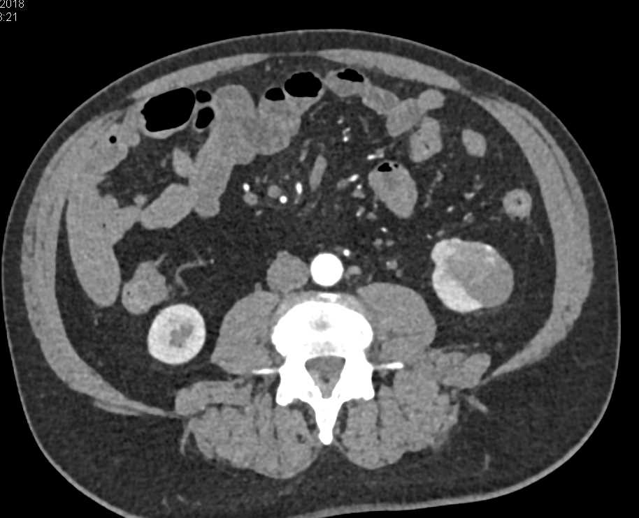 Cystic Renal Cell Carcinoma - CTisus CT Scan