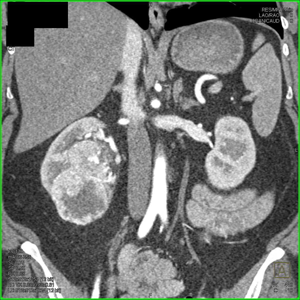 Clear Cell Renal Cell Carcinoma - CTisus CT Scan