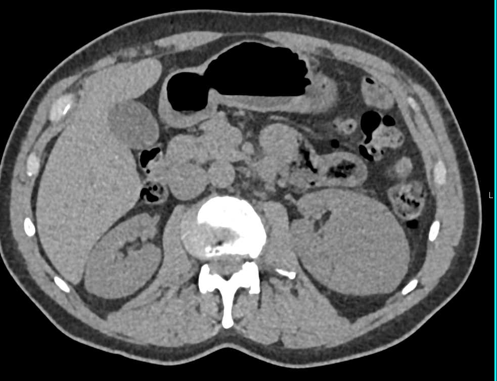 Bosniak 2 Cyst - CTisus CT Scan