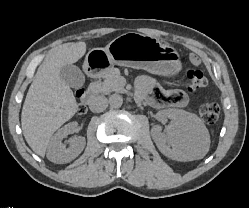 Bosniak 2 Cyst - CTisus CT Scan