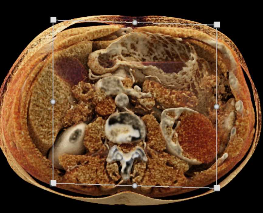 Bosniak 2 Cyst - CTisus CT Scan