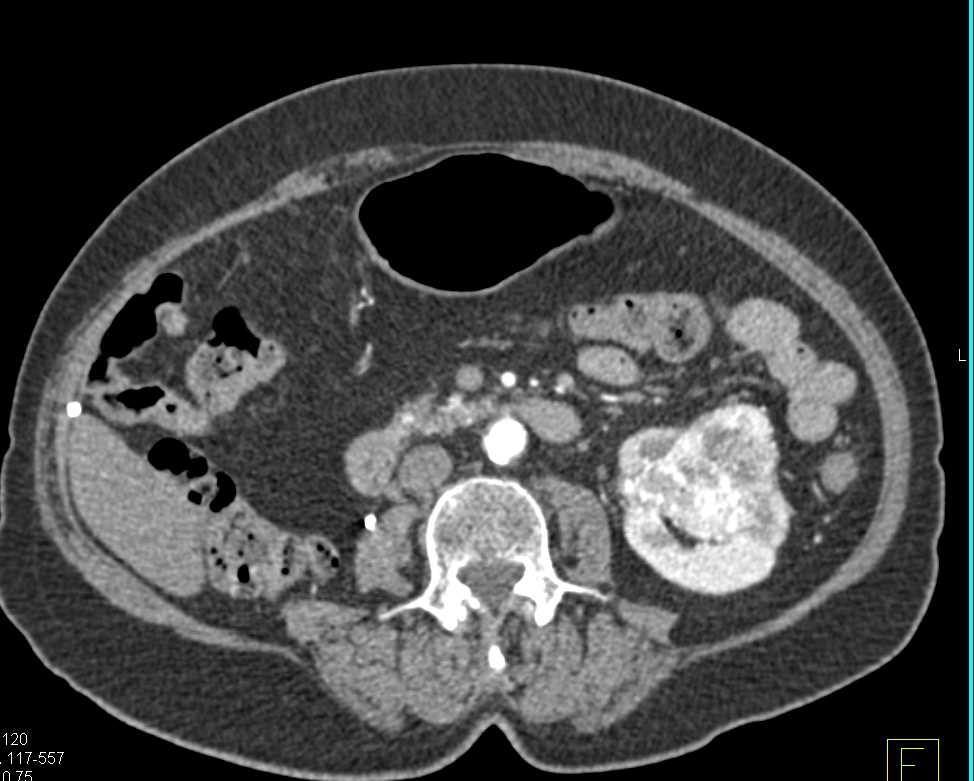 Clear Cell RCC with Metastases to the Pancreas - CTisus CT Scan