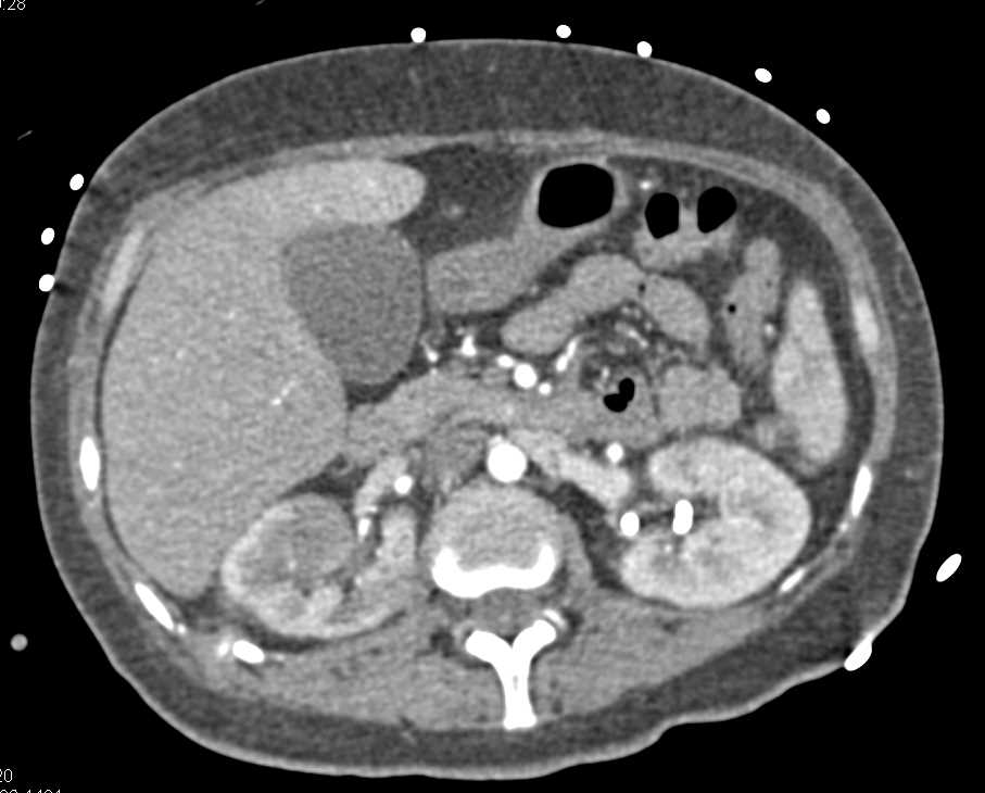 Acute Pyelonephritis Right Kidney - CTisus CT Scan