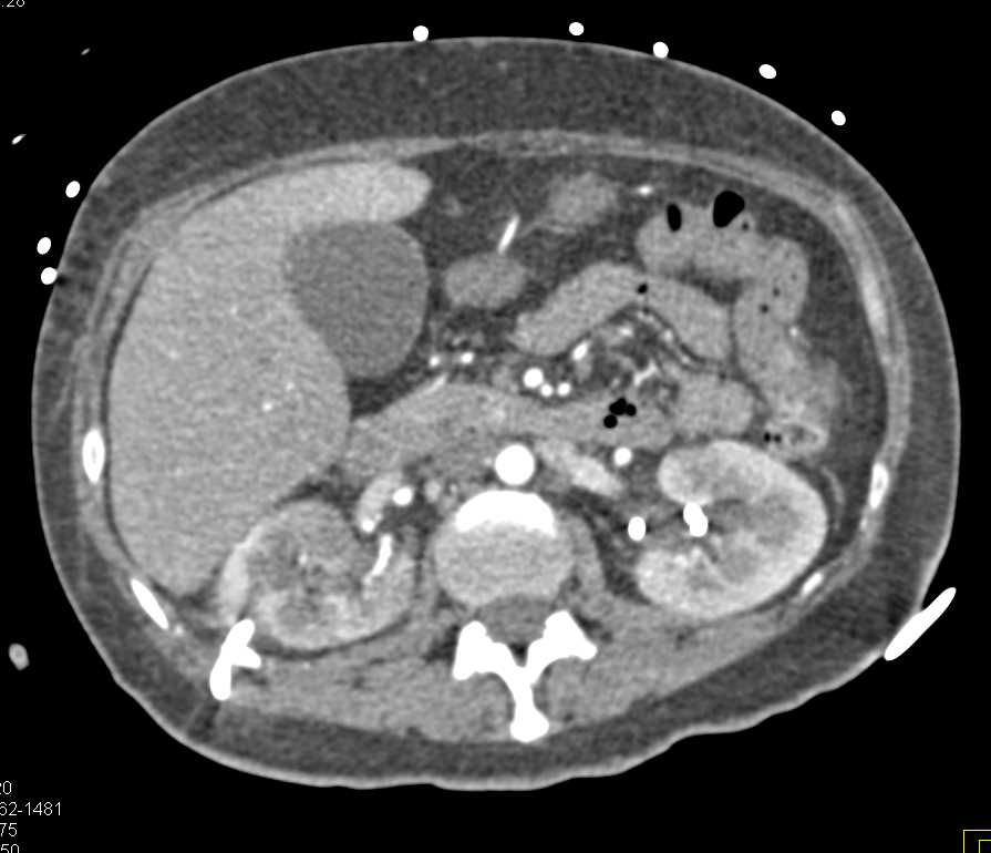 Acute Pyelonephritis Right Kidney - CTisus CT Scan