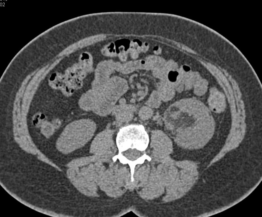 Left Renal Myelolipoma - CTisus CT Scan