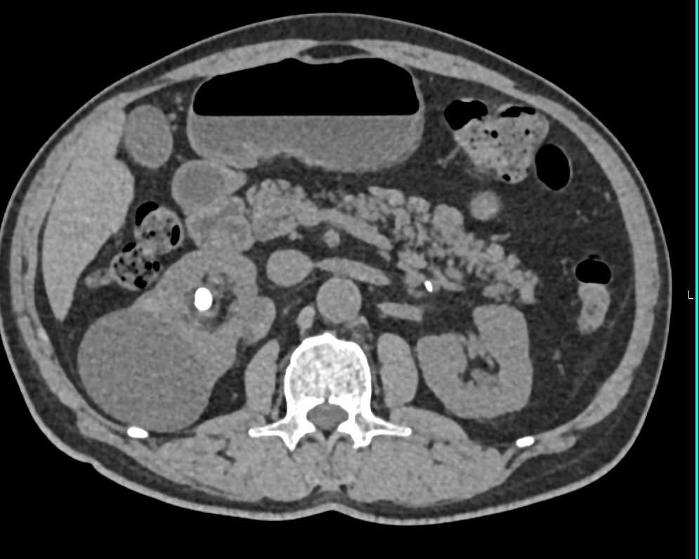 Transitional Cell Carcinoma Right Kidney and Bladder - CTisus CT Scan