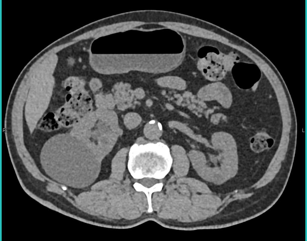 Transitional Cell Carcinoma Right Kidney and Bladder - CTisus CT Scan