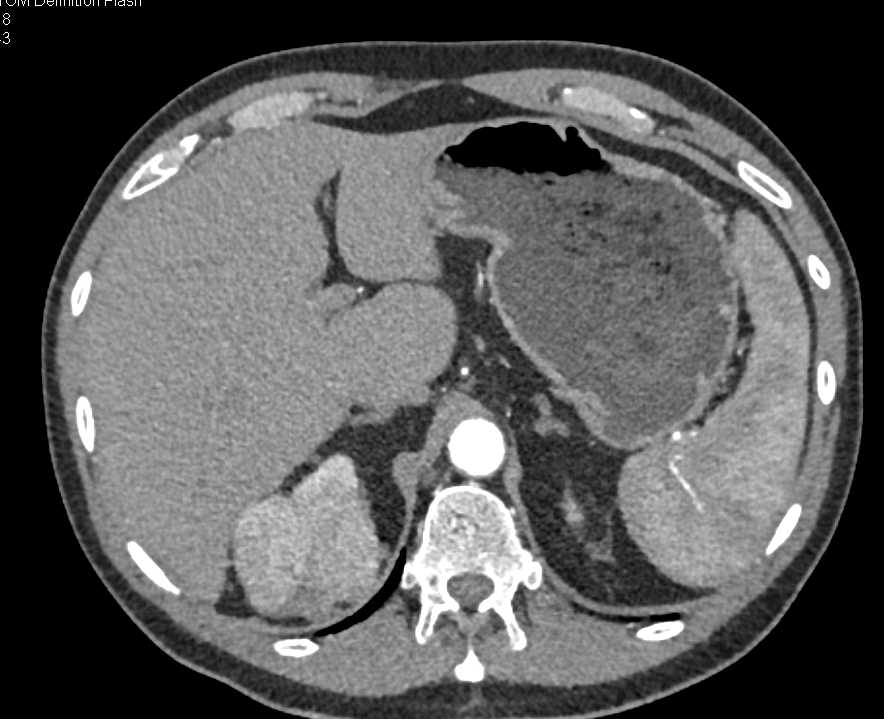 Renal Lymphoma - CTisus CT Scan