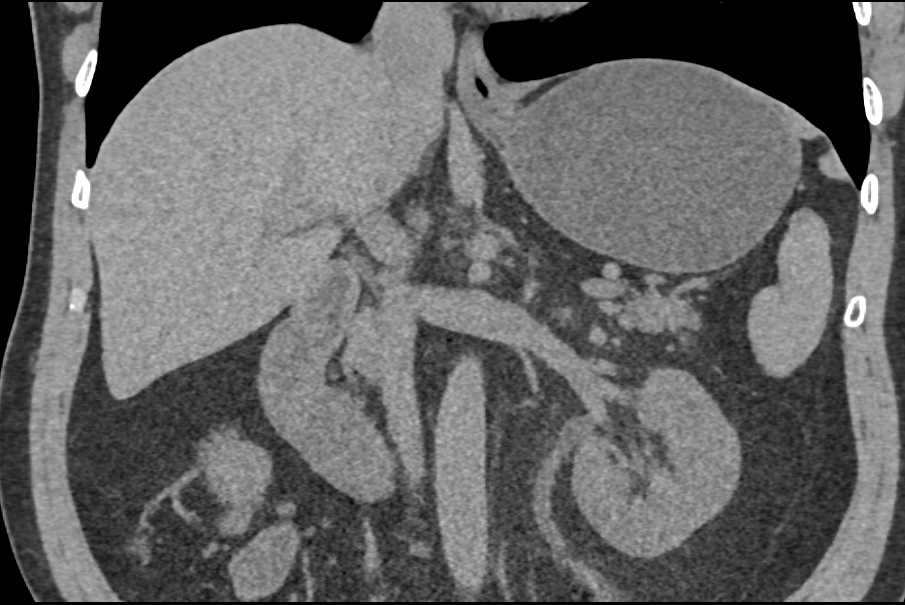 Duplicated Right Collecting System - CTisus CT Scan