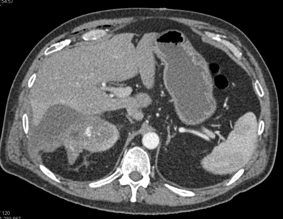 Neovascularity and Renal Cell Carcinoma - CTisus CT Scan