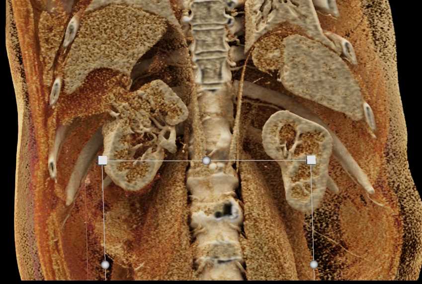 Neovascularity and Renal Cell Carcinoma - CTisus CT Scan