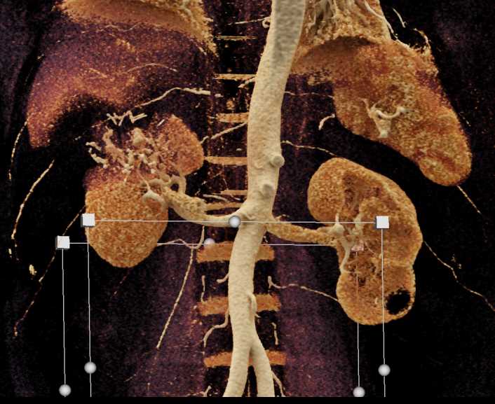 Neovascularity and Renal Cell Carcinoma - CTisus CT Scan