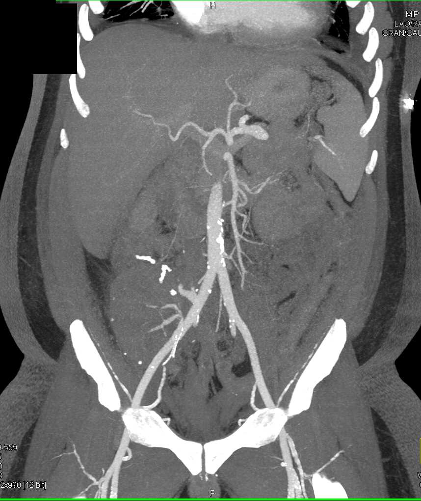 Failed Renal Transplant - CTisus CT Scan