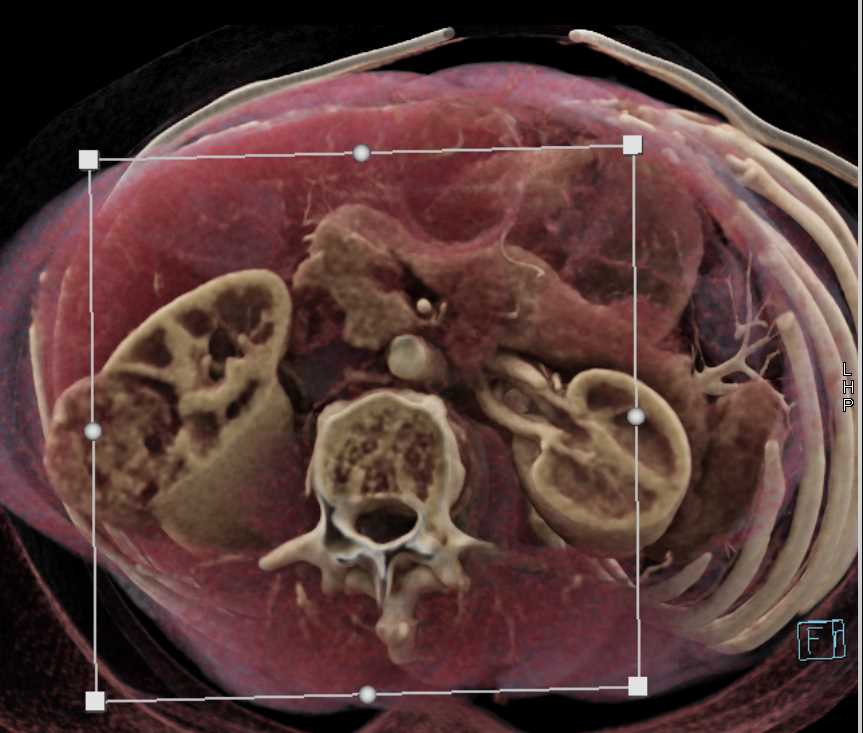 Clear Cell Renal Cell carcinoma - CTisus CT Scan