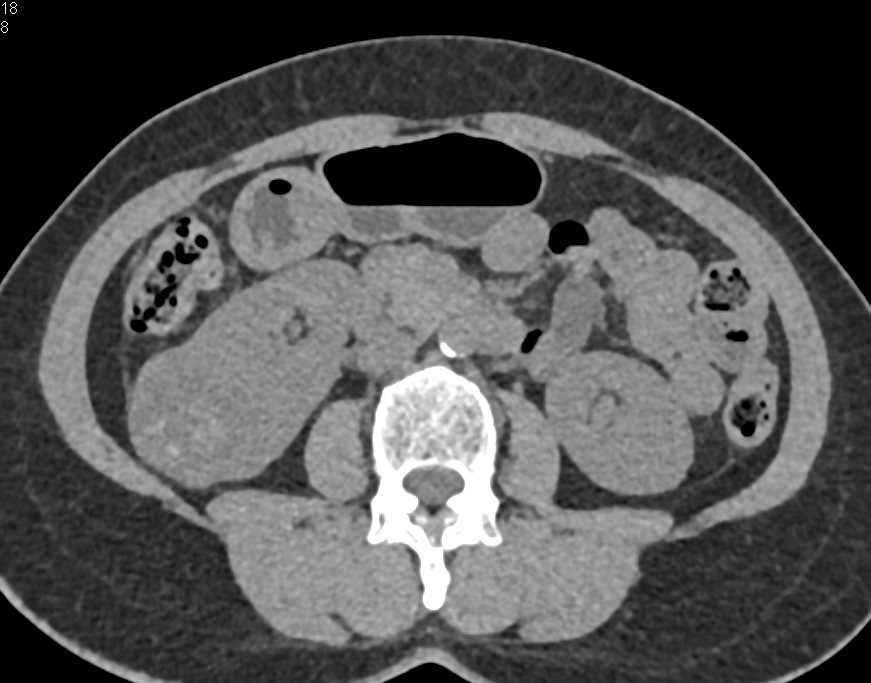 Clear Cell Renal Cell carcinoma - CTisus CT Scan