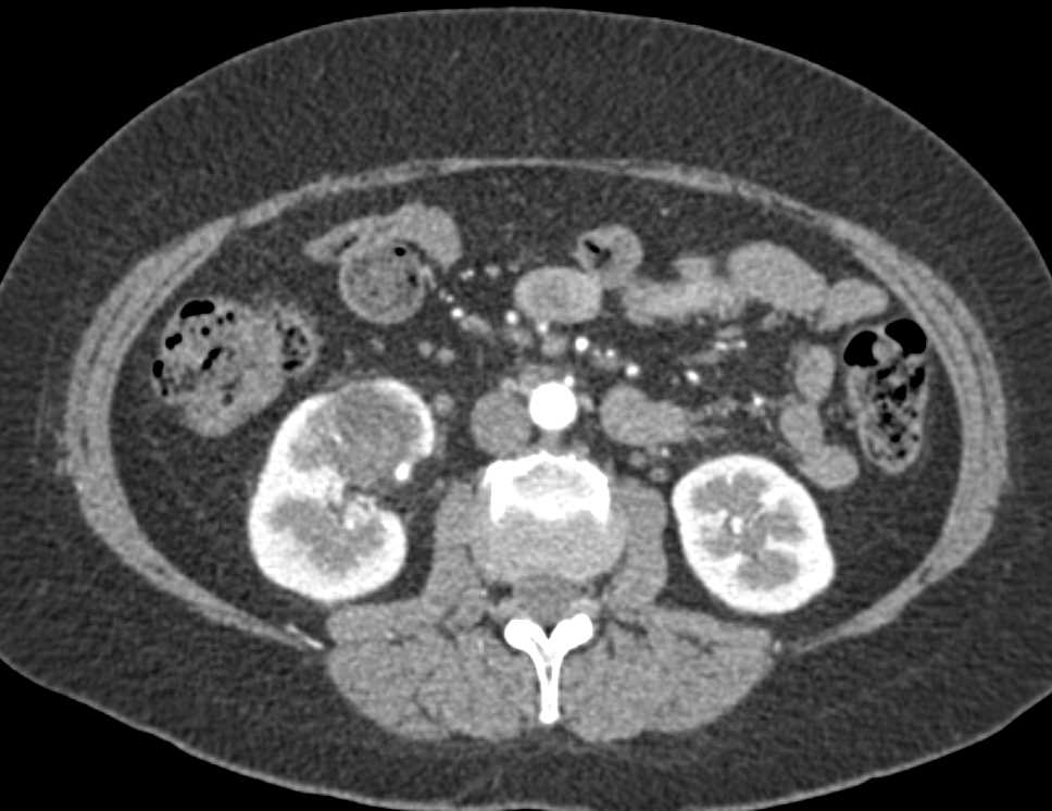 Calcified Cyst Right Kidney - CTisus CT Scan