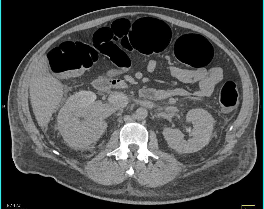 Renal Cell Carcinoma Invades the Right Renal Vein and the IVC - CTisus CT Scan