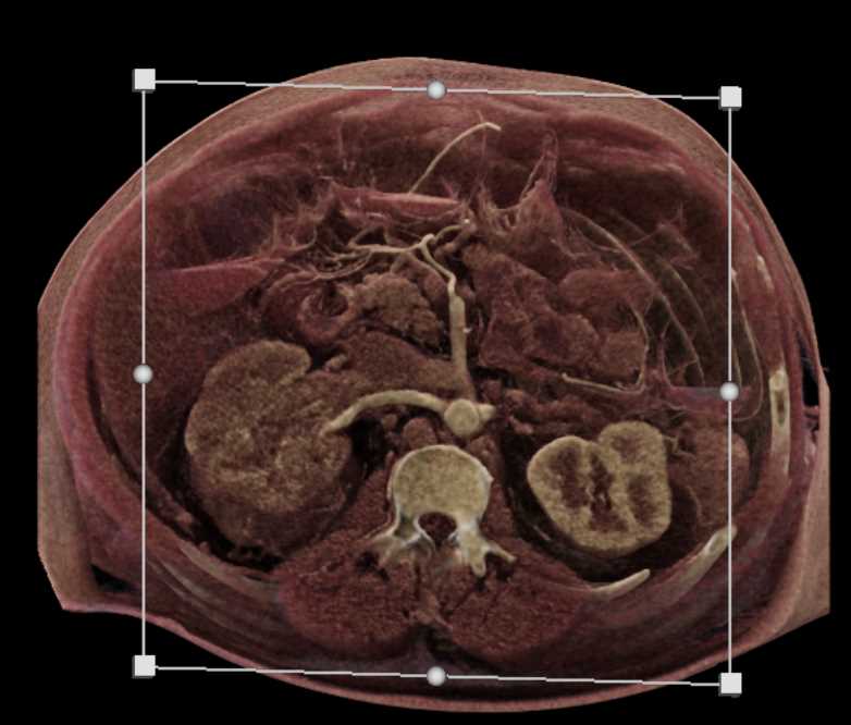 Renal Cell Carcinoma Invades the Right Renal Vein and the IVC - CTisus CT Scan