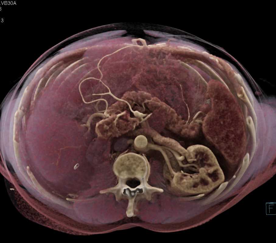 Left Nephrectomy with Cinematic Rendering - CTisus CT Scan