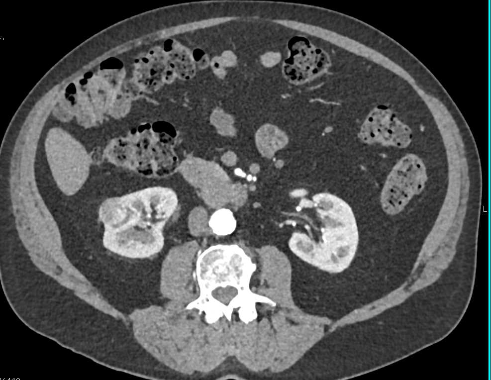 Renal Cell Carcinoma Lower Pole Right Kidney - CTisus CT Scan