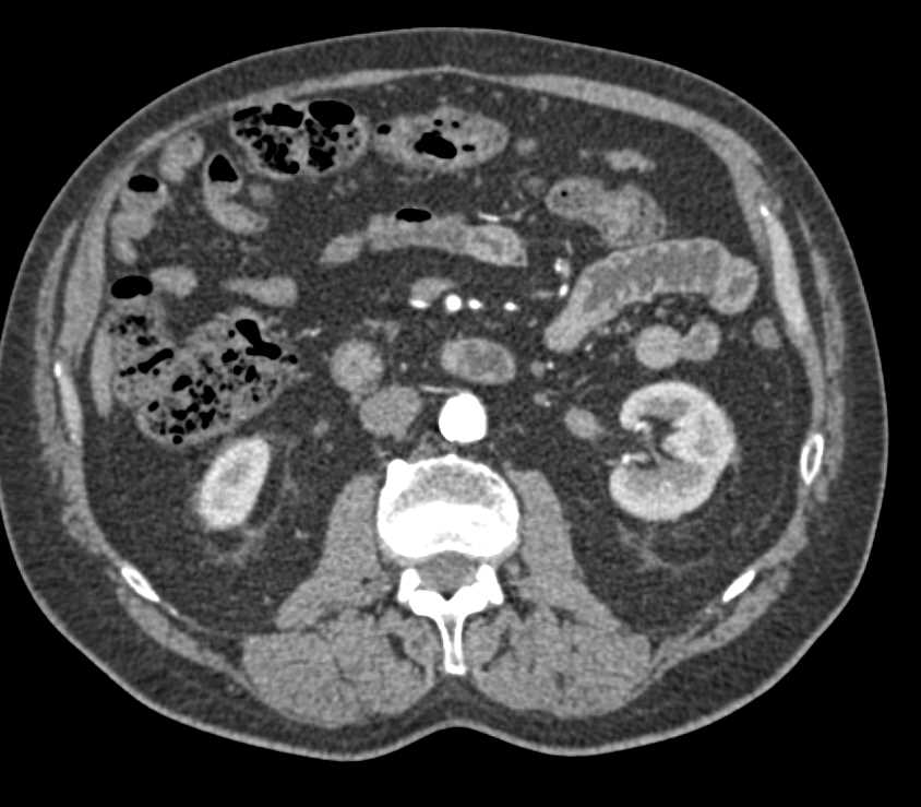 Transitional Cell Carcinoma Left Renal Pelvis - CTisus CT Scan
