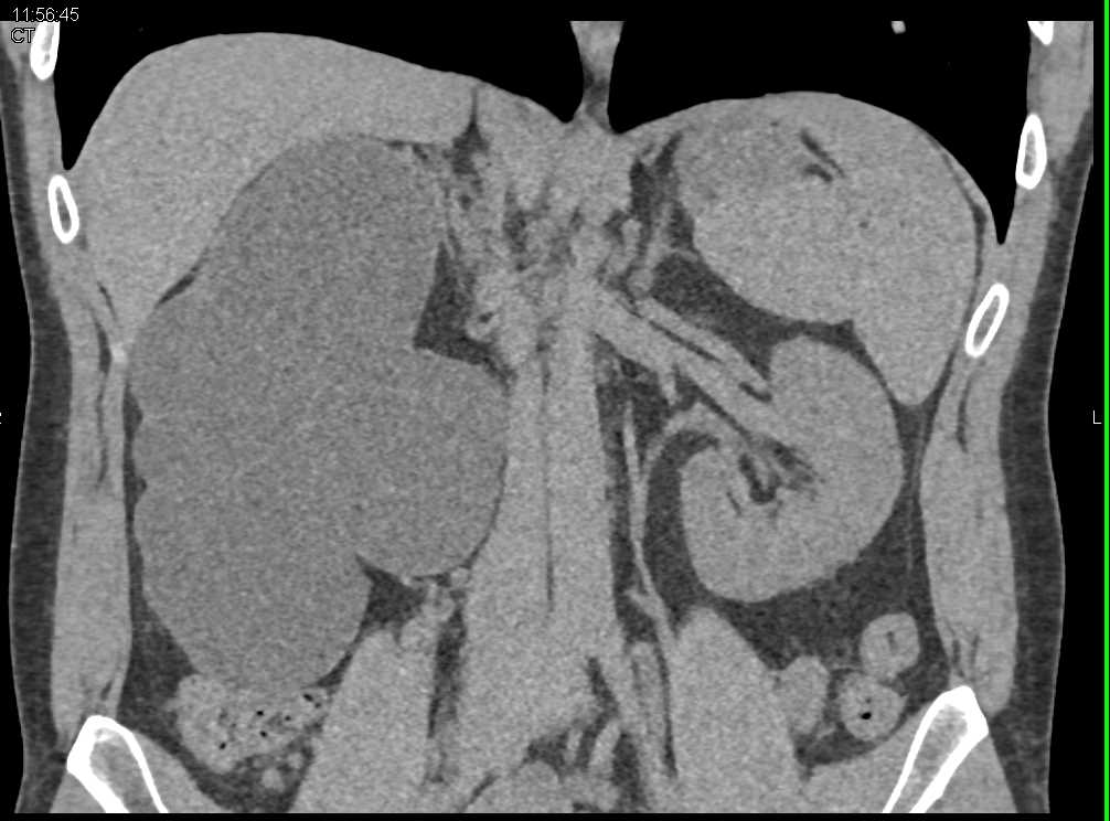 Congenital Right UPJ Obstruction - CTisus CT Scan