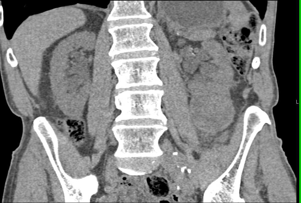 Cystic Renal Cell Carcinoma Lower Pole Left Kidney - CTisus CT Scan