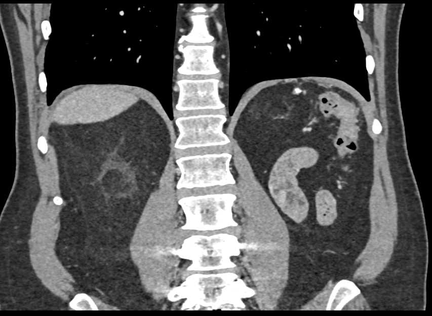 Normal Left Nephrectomy Bed - CTisus CT Scan