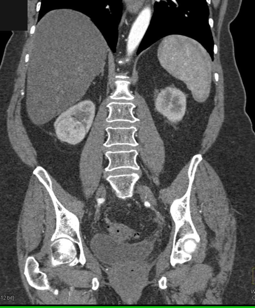 Oncocytoma Right Kidney - CTisus CT Scan