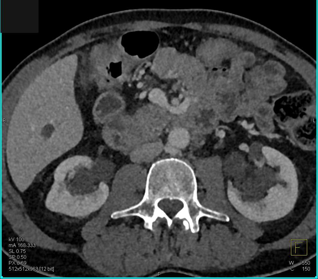 CTisus CT Scanning | Parapelvic Cysts in the Kidneys