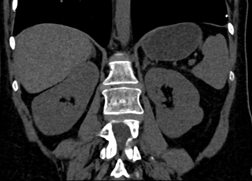 Bilateral Renal Oncocytomas - CTisus CT Scan