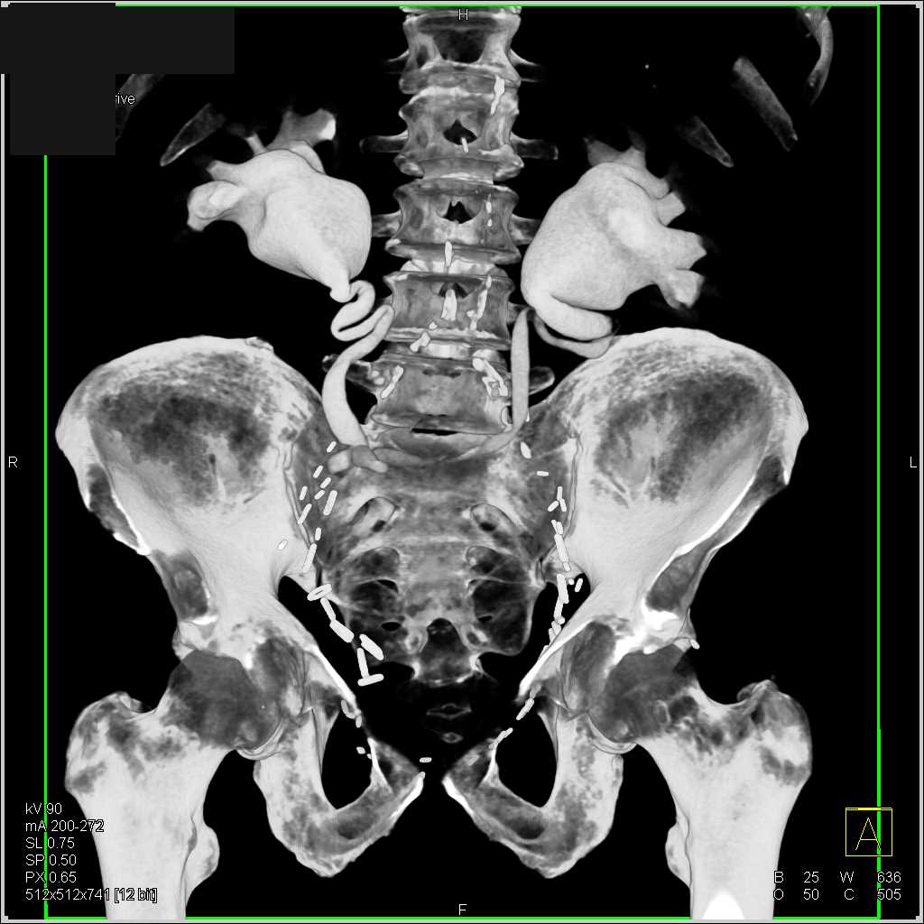 Bilateral Hydronephrosis and Reimplanted Ureters - CTisus CT Scan