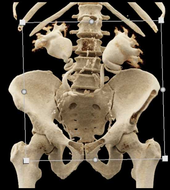 Bilateral Hydronephrosis and Reimplanted Ureters - CTisus CT Scan