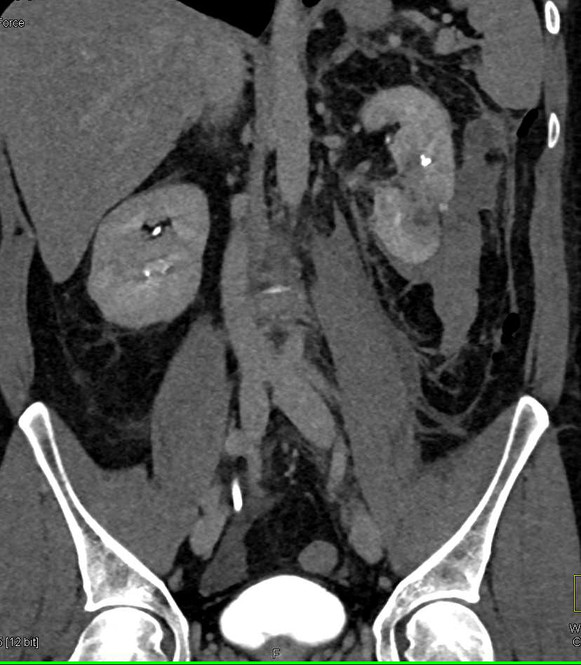 Renal Artery Pseudoaneurysm and Bleed - CTisus CT Scan