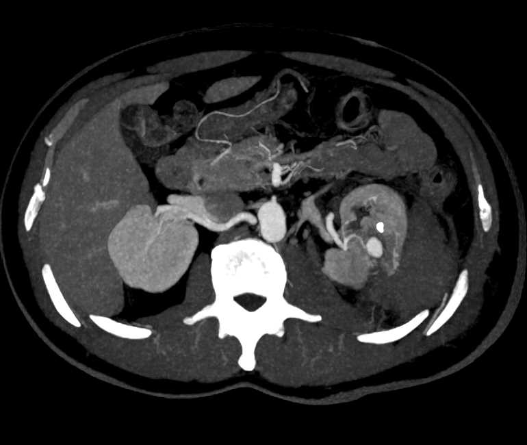 Renal Artery Pseudoaneurysm and Bleed - CTisus CT Scan